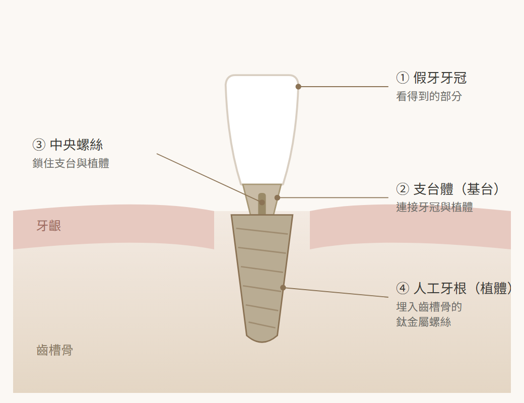 植牙結構示意圖：假牙牙冠、支台體、中央螺絲與人工牙根植體