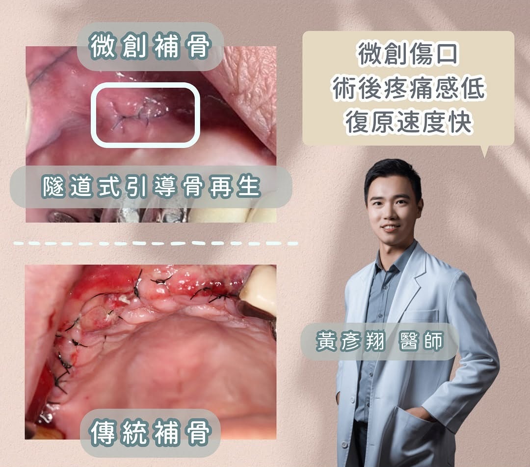 微創補骨與傳統補骨的傷口比較